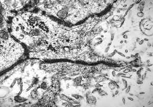 F,11y. | ependymoma F,11y. | ependymoma